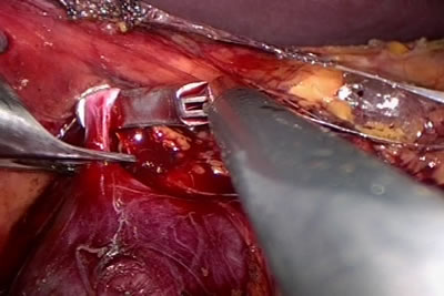 Наложена клипса на сосуд
