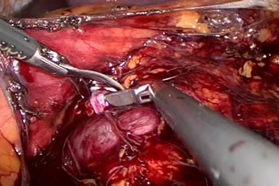 Наложена клипса на сосуд