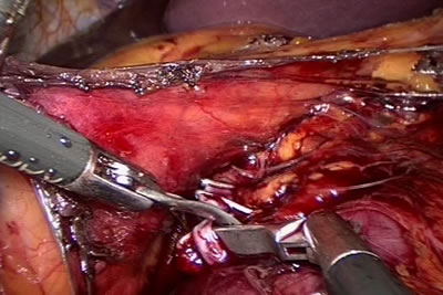 Между наложенными клипсами сосуд рассекается ножницами