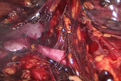 Идет выделение сосудистой ножки почки