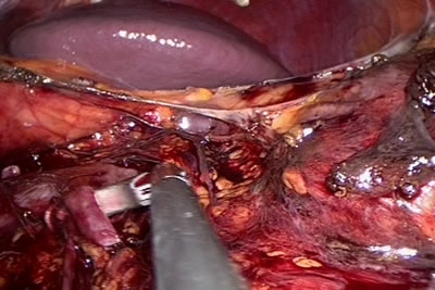 Идет выделение сосудистой ножки почки