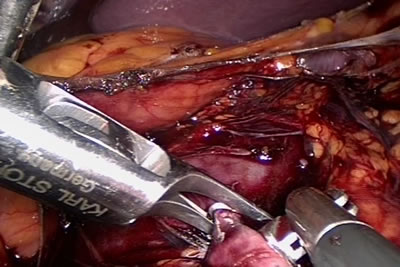 На сосуд накладывается клипса