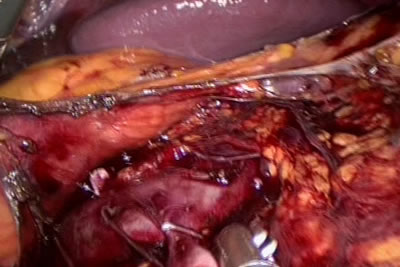 Сосуд лигирован клипсой