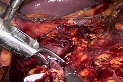 Сосуд лигирован клипсой