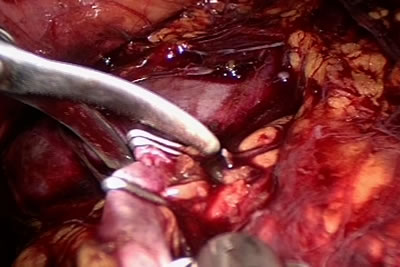 Сосуд лигирован клипсой