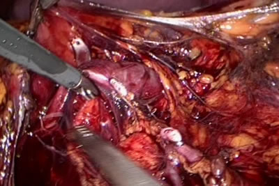 Обработка сосудистой ножки левой почки