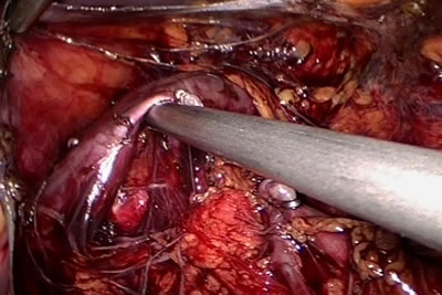 Обработка сосудистой ножки левой почки