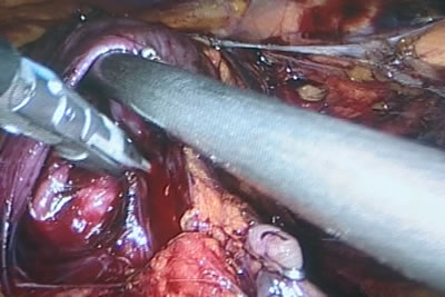 Обработка сосудистой ножки левой почки