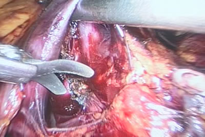 Обработка сосудистой ножки левой почки