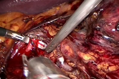 Обработка сосудистой ножки левой почки