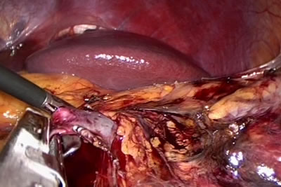 Обработка сосудистой ножки левой почки