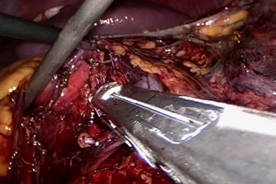 Почечная вена прошивается аппаратом рядом скрепок