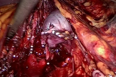 Скрепки наложены, почечная вена пересечена