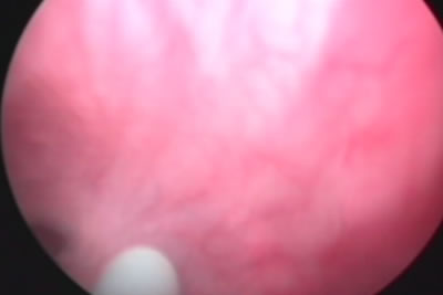 Через рабочий канал к стриктуре проводится мочеточниковый катетер