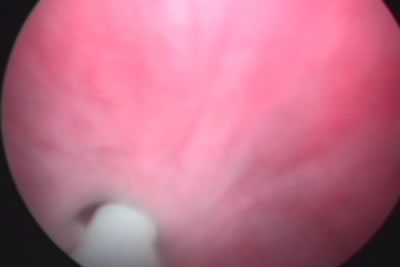 Мочеточниковый катетер проведен через суженное отверстие уретры