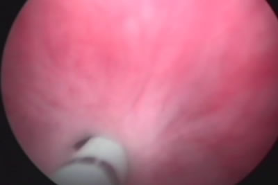 Мочеточниковый катетер проведен через суженное отверстие уретры