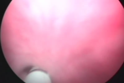 Мочеточниковый катетер проведен через суженное отверстие уретры