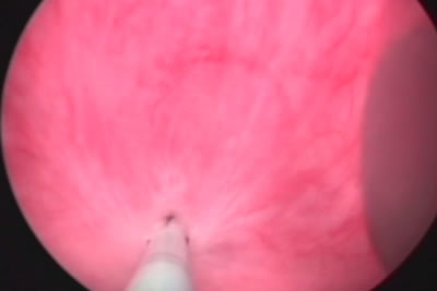 Катетер проведен до мочевого пузыря