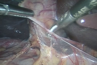 Освобождение желчного пузыря и печени из спаек