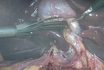 Печень отведена специальным инструментом, который расправляется в брюшной полости в виде веера