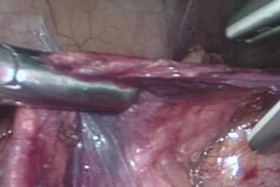 Рассекается париетальная брюшина для доступа к правой почке