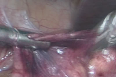 При рассечении брюшины активно используется аппарат LigaSure