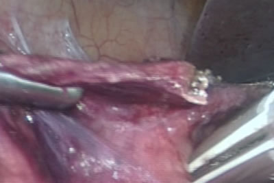 При рассечении брюшины активно используется аппарат LigaSure