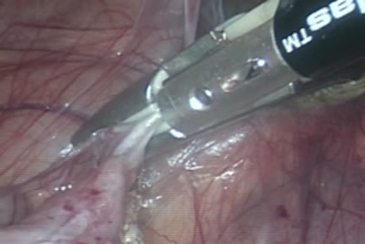 Идет рассечение париетальной брюшины по правому боковому каналу