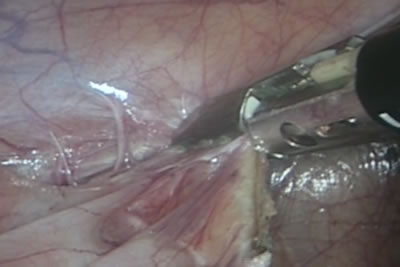 Идет рассечение париетальной брюшины по правому боковому каналу