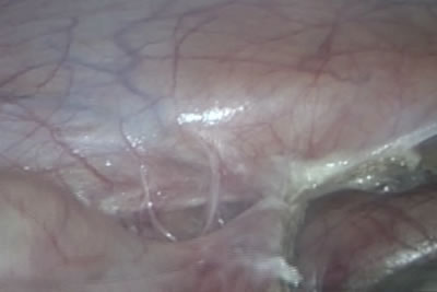 Идет рассечение париетальной брюшины по правому боковому каналу