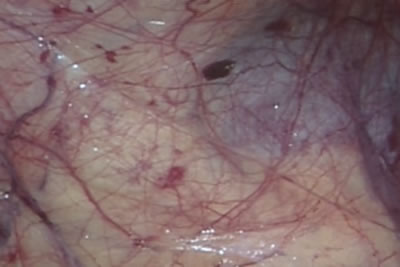 На снимке видна почка просвечивающаяся сквозь фасцию