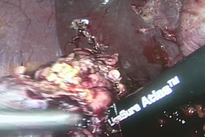 Почка выделяется по задней поверхности