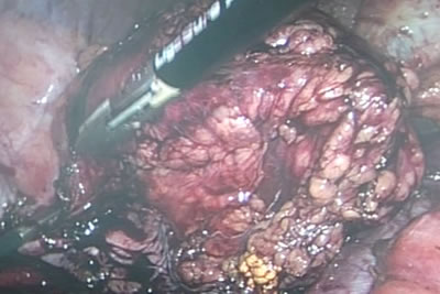 Почка с паранефральной клетчаткой полностью выделена и свободно находится в брюшной полости