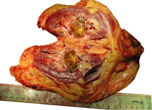 Инцидентальная опухоль левой почки T1а N0 M0